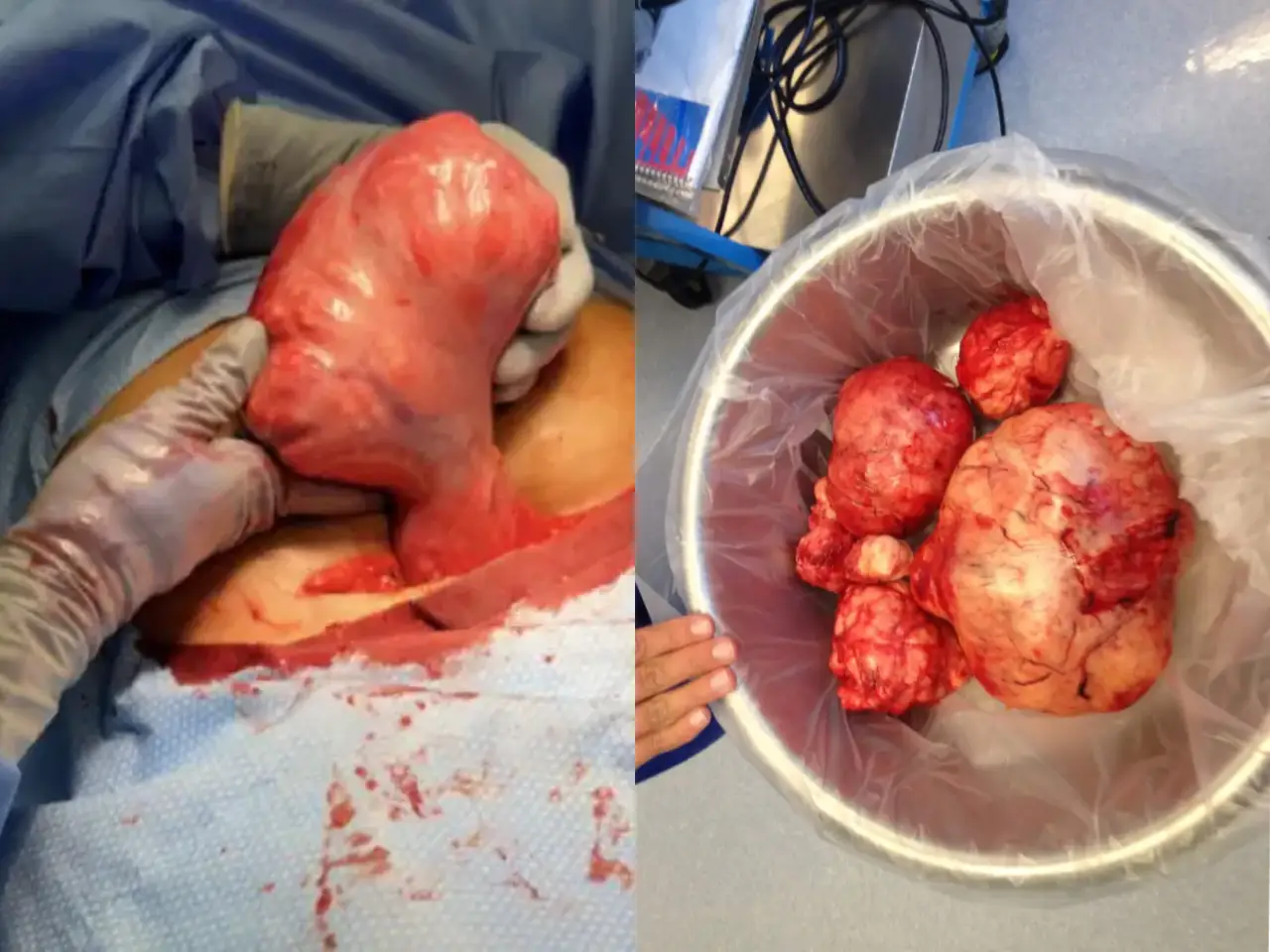 Understanding Different Fibroid Locations and Types