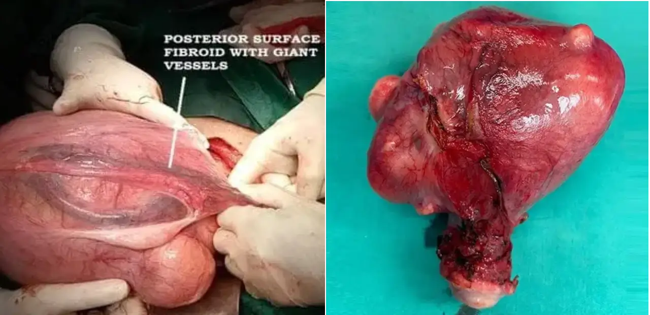 Ultrasound Scan Showing Fibroid Growth vs Shrinkage