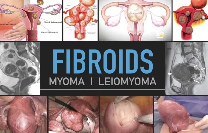 Natural Fibroid Solution